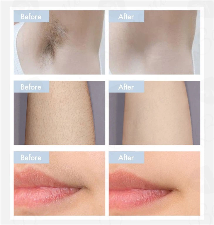 2024 Manufacturer Price Diode Laser Hair Removal Machine