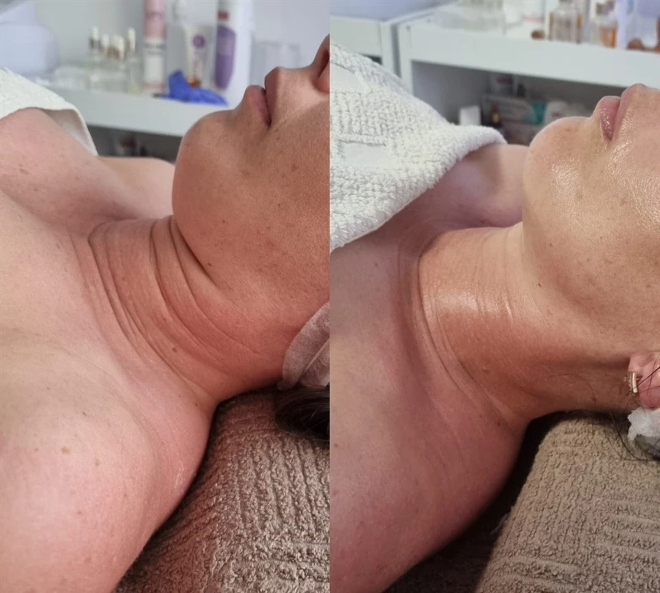 SlimSphere Roller Therapy
