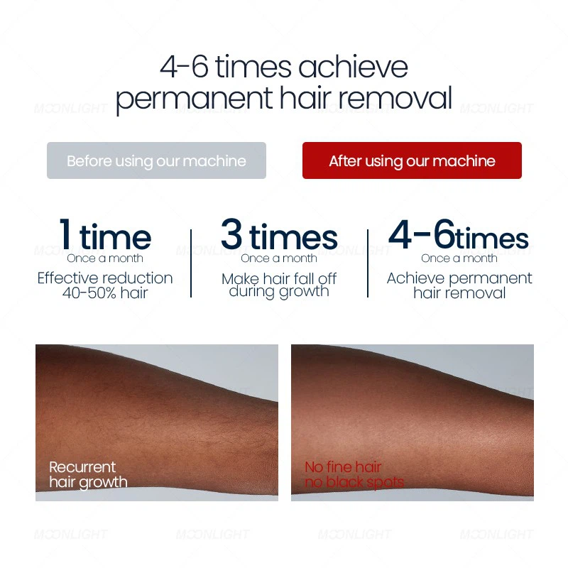 Soprano Titanium Diode Laser Hair Removal Machine – Advanced Professional Solution best